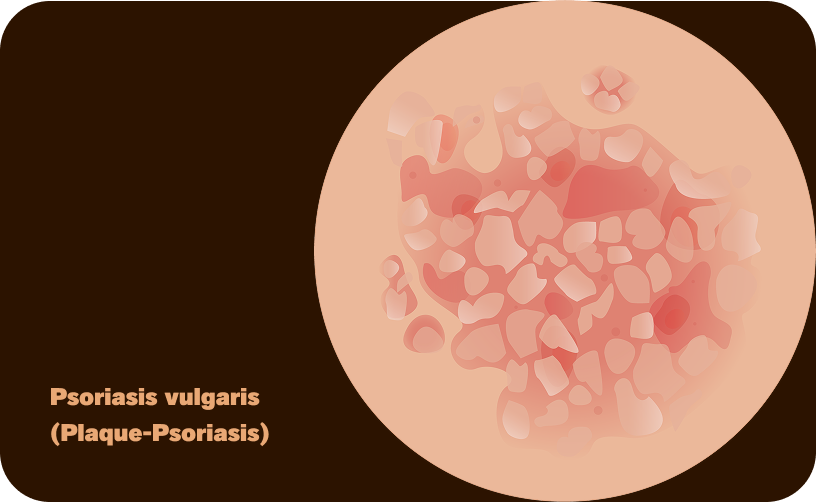 Vulgaris-DE-ohne Text